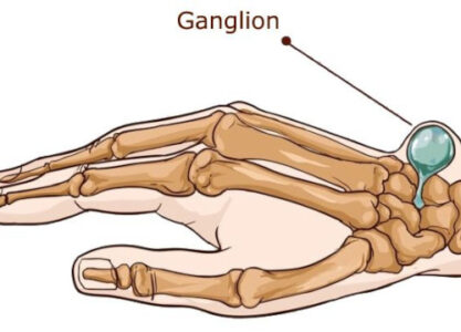 Ganglion