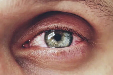 Retinopatia cukrzycowa