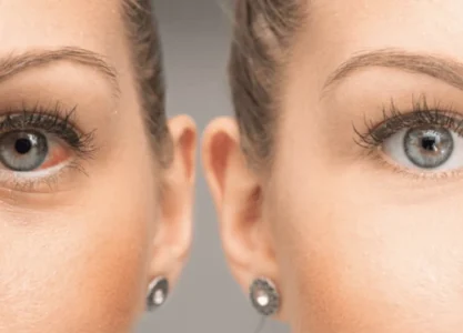 Jaskra młodzieńcza