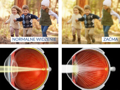 Zaćma i jej diagnozowanie