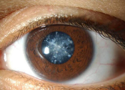 Zaćma i jej diagnozowanie